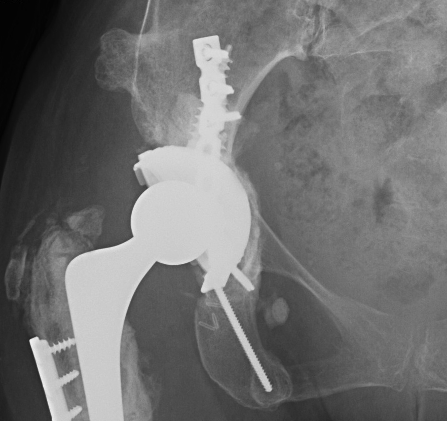 Revision THR Plate Posterior Column